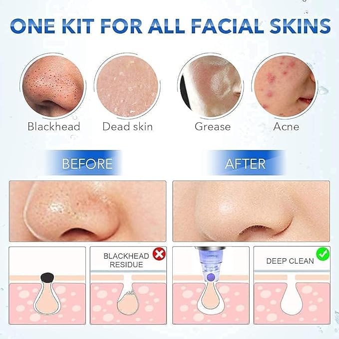 WYNXCARE Blackhead Remover Tool | Silicone Blackheads Removal Suction Machine, Replaces Nose Strips | Pimple Acne Pore Remover Tool, 4 In 1 Multi-Function Remove Blackheads For Men & Women